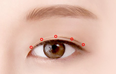 원하는 라인에 따라 조직 상태를 고려하여 구멍 위치 디자인 - 눈매교정