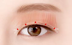 라인 고정 후 자연유착 - 눈매교정