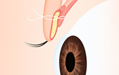 최적의 위치에 눈매를 교정 - 눈매교정
